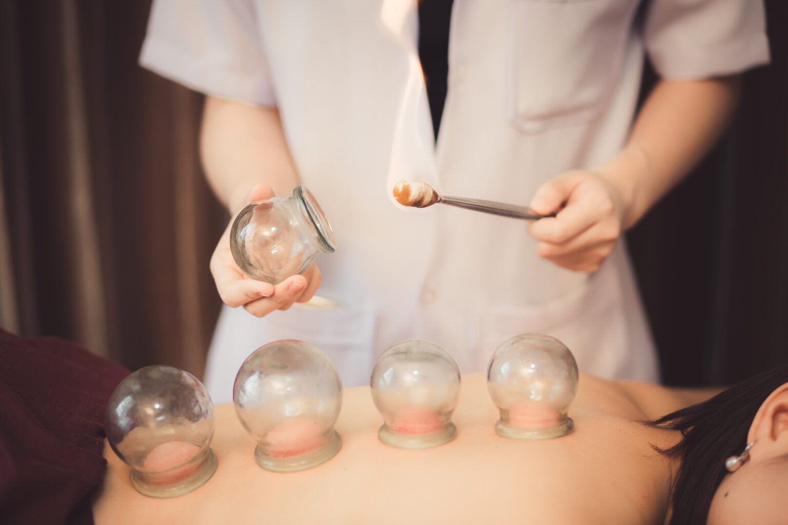 What are the Benefits of Using Cupping? SOHMA Integrative Medicine